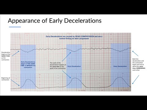 Fetal Monitoring Part 2: Understanding Early Decelerations