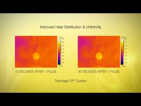 Thermage CPT skin tightening treatment