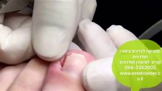 טכניקה לגזירת ציפורן חודרנית 054-3342002