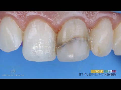 Odbudowa bezpośrednia - bonding - licówka kompozytowa na przebarwionego zęba