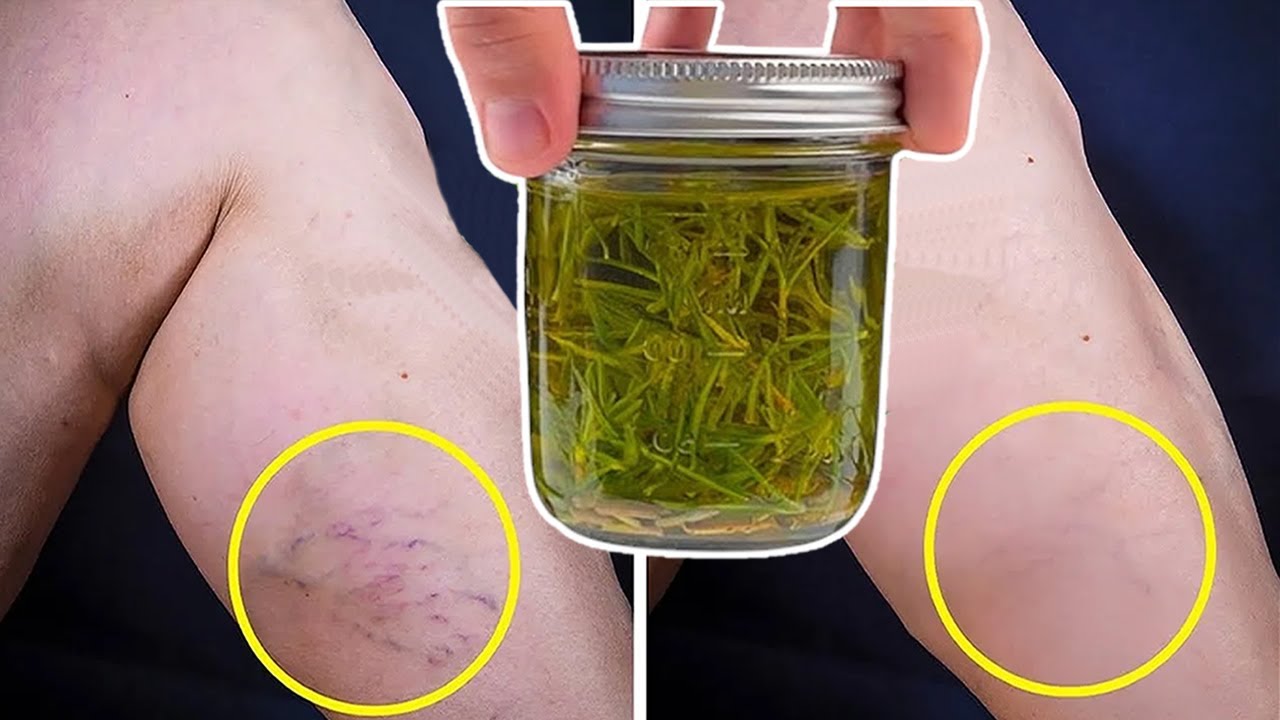 This Recipe Got Rid of My Varicose Veins, and I Just Had to Use This 🔝