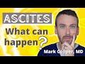 What Is ASCITES Symptoms And Complications