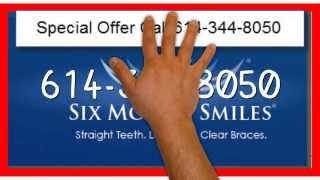 preview picture of video 'Adult Braces Grove City Oh|614-344-8050|Clear Braces Grove City Ohio'