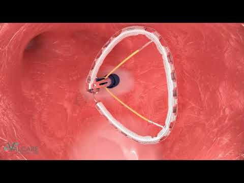 Valcare AMEND Transeptal Mitral Repair annuloplasty NF1021