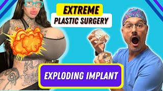 Huge Breast Implants - Extreme surgery