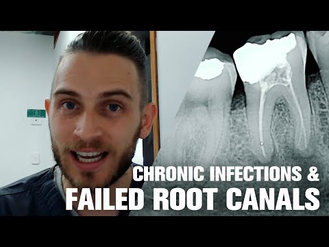 Dentist reveals - How To Tell If You Have Chronic Tooth Infection