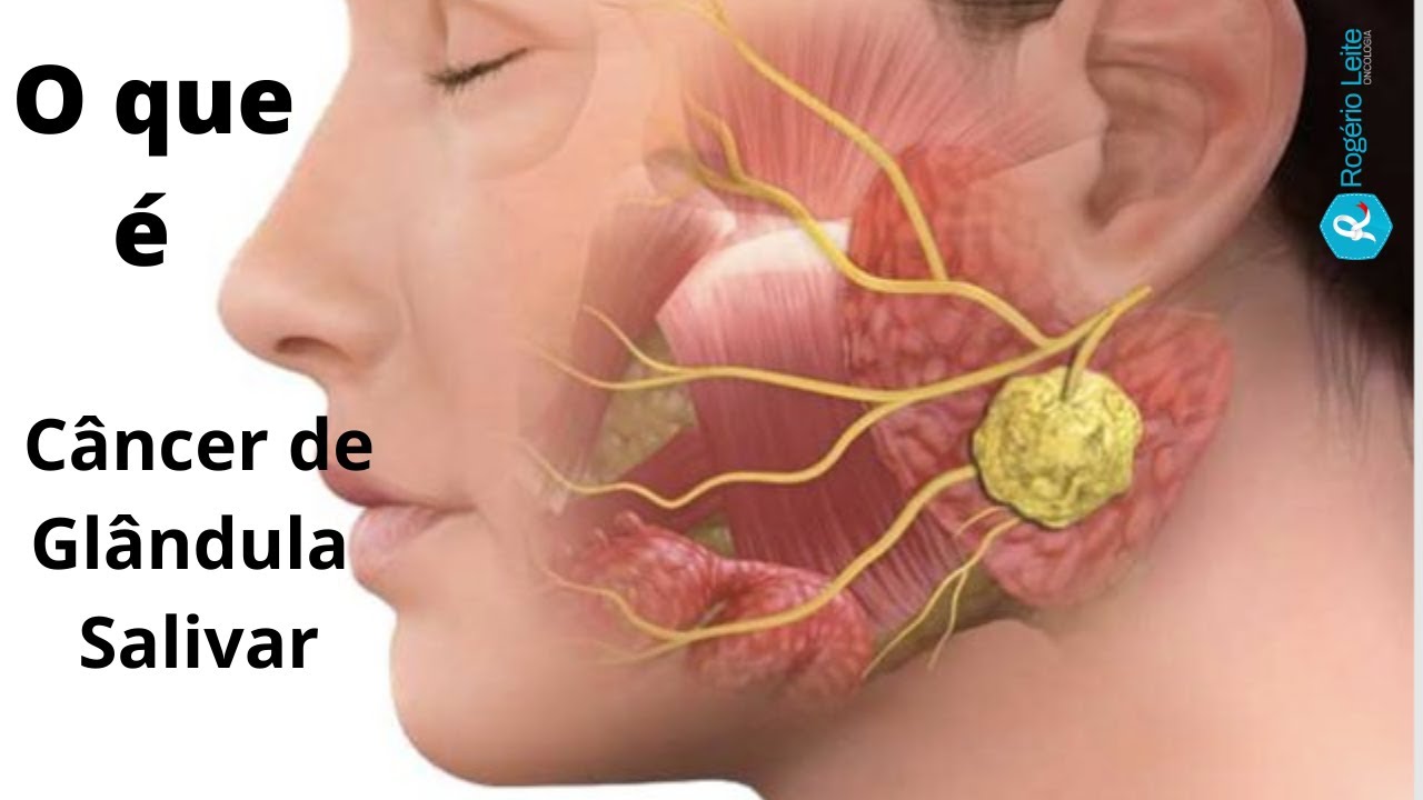 O que é e como tratar o câncer de glândula salivar 094 - Dr. Rogério Leite