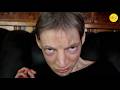 Living With The Cat Cry Syndrome Cri Du Chat
