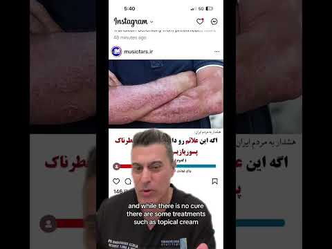 Psoriasis Treatment! Skin Condition Breakdown