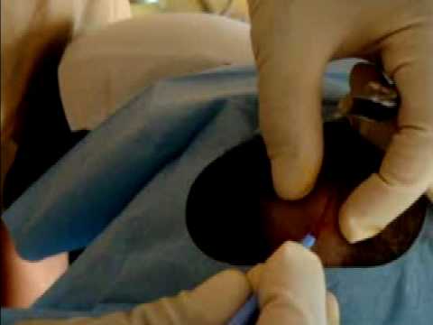 comment soigner un kyste à l'aine