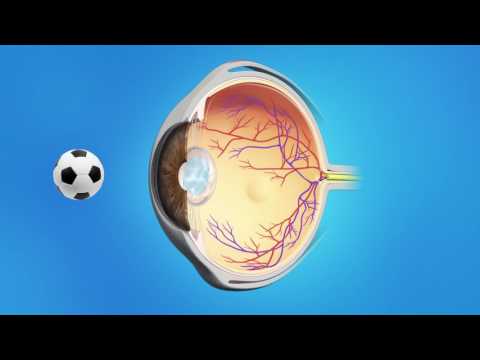 YAG Capsulotomy After Cataract Surgery
