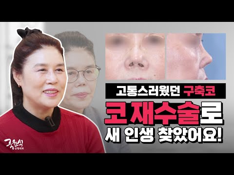 세 번의 코재수술에도 구축이 심했던 코, 국원석성형외과에서 새 인생 찾은 리얼 후기!