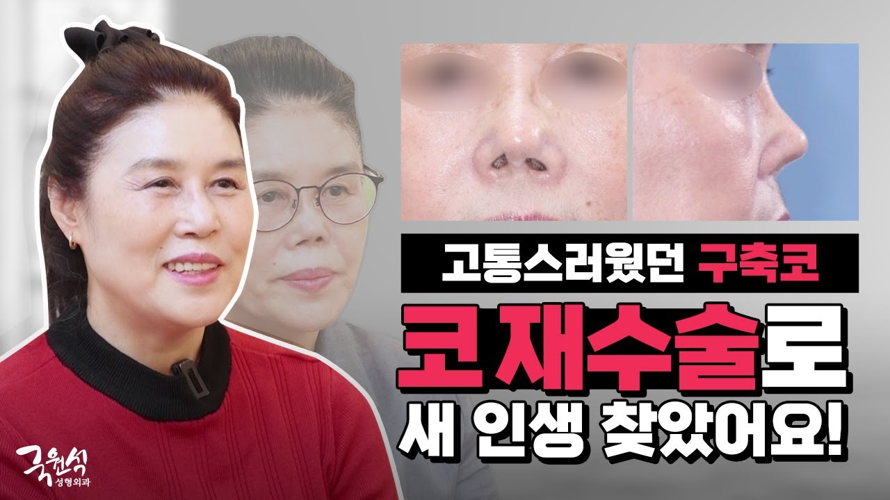 세 번의 코재수술에도 구축이 심했던 코, 국원석성형외과에서 새 인생 찾은 리얼 후기! 썸네일
