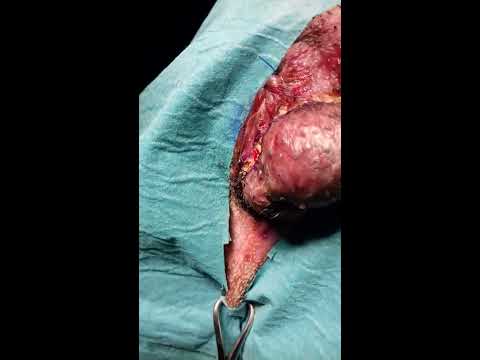Massager della prostata di acquistare in una farmacia a Mosca Tremula nel trattamento di adenoma prostatico