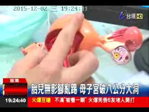 104.12.02台視：無影腳寶寶 踹破子宮 母女險喪命