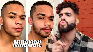Evolução dos INSCRITOS - MINOXIDIL 🧔