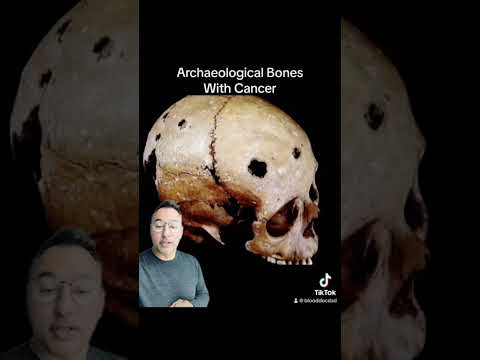 Bones with cancer #bones #cancer #trending #oncology #history #youtubeshorts #medicine