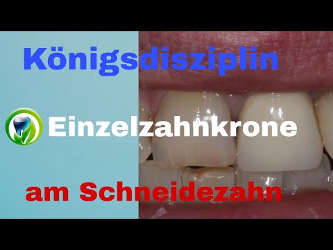 Königsdisziplin Einzelzahnversorgung Frontzahn  Schneidezahn | Vollkeramik Krone im Frontzahnbereich