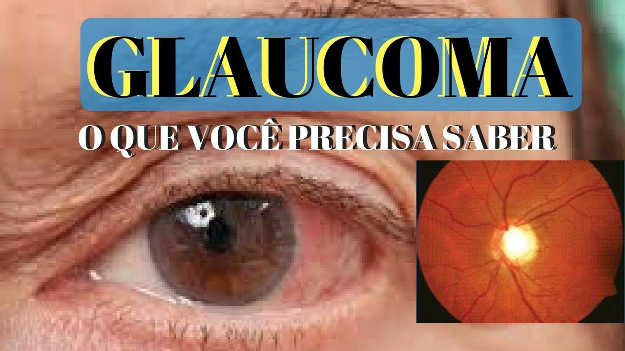 GLAUCOMA: what is it and what are its symptoms? | Dr. André Wambier