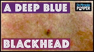 A blue-black, sticky blackhead extracted