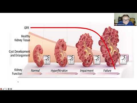 Video: IMPEDE-PKD trial by Dr Ragada El-Damanawi