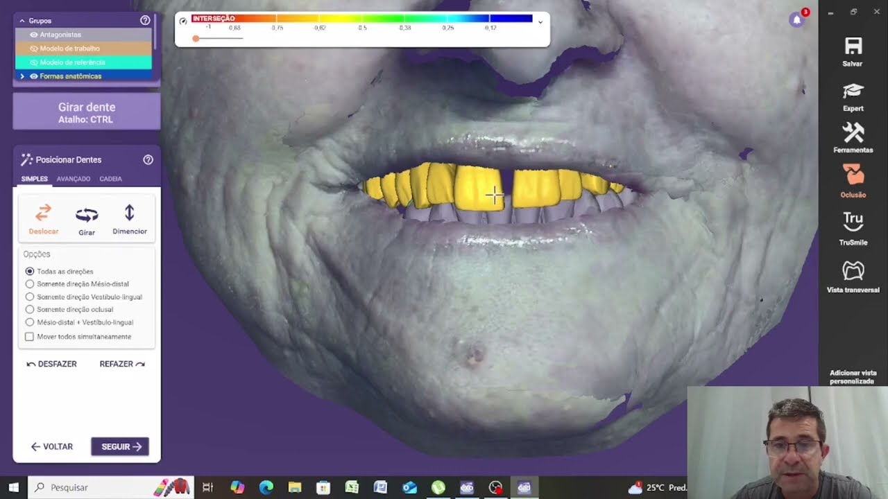 Confecção de uma Prótese Total ( Dentadura) no Exocad e na Impressora 3D de Resina