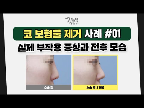 코 보형물 제거로 걱정 중이라면❓ 사례를 확인해 보세요 #01