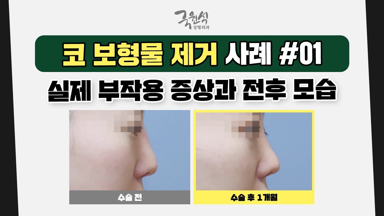 코 보형물 제거로 걱정 중이라면❓ 사례를 확인해 보세요 #01