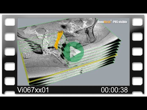 DynaMesh® MRI - Animation: MRI Reconstruction with DynaMesh®-PRS visible