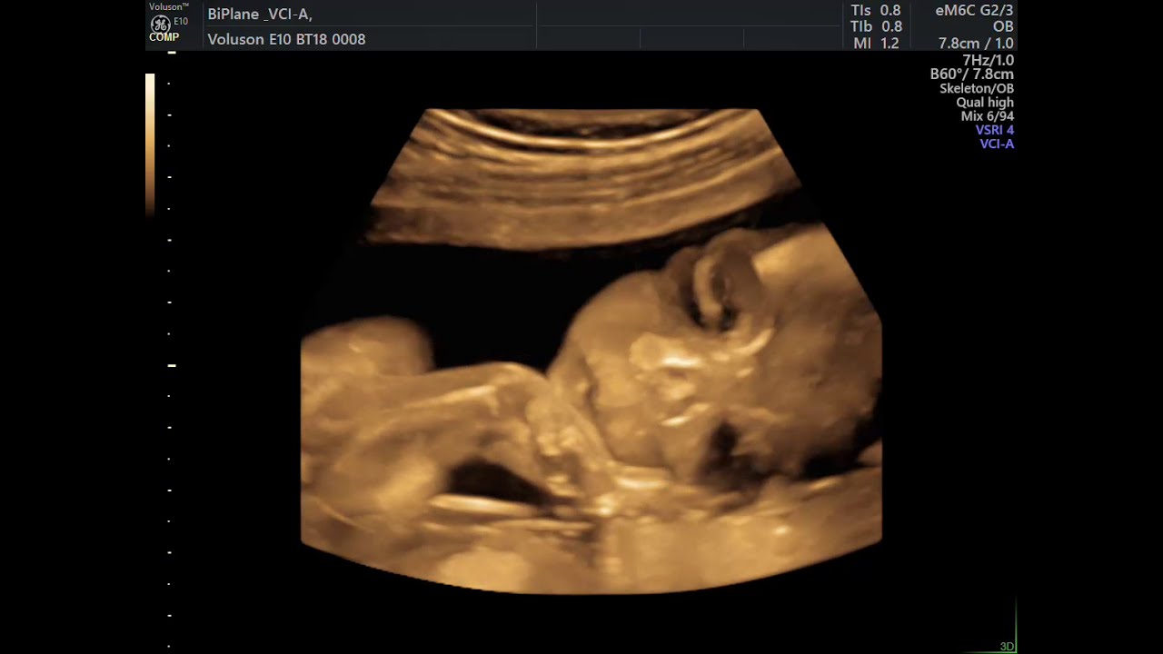 ULTRASSON 4D MÃO NO QUEIXO