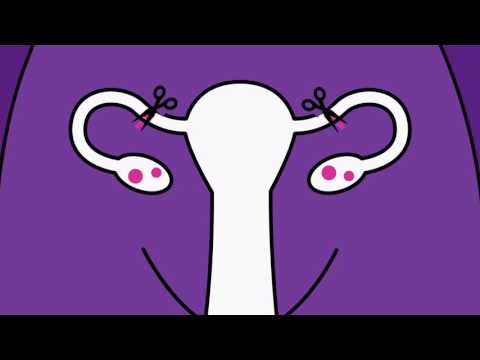 Brook Contraception - Sterilisation Animation