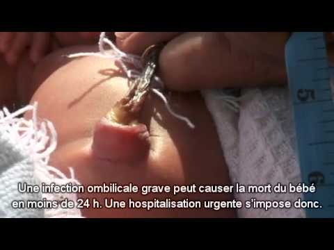 comment soigner le cordon ombilical de bébé