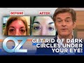 How To Get Rid Of Dark Circles Under Your Eyes Oz Beauty Skincare