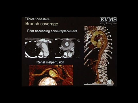 Proximale Aortendissektion und andere Katastrophen nach TEVAR-Einsatz