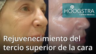 Rejuvenecimiento del tercio superior de la cara (20115)