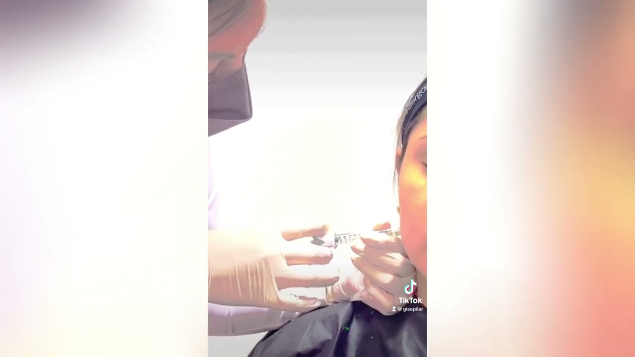 Ácido Hialurónico para marcaje mandibular
