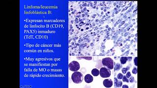 Linfoma no Hodgkin B (Parte 1)