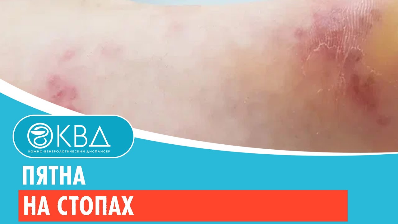 🤷‍♂️ Пятна на стопах. Клинический случай №342