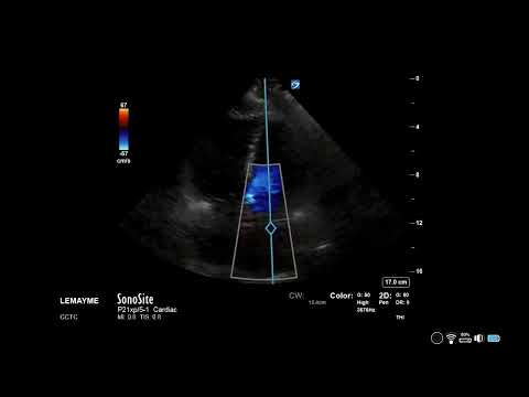How to...Measure MVA using PHT or Deceleration Time