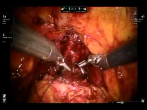 Anastomosis - Robotic Assisted Laparoscopic Prostatectomy (RALRP)