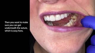 How to remove dental sutures.