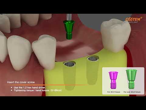 Osstem - TSIII fixture with Transfer Abutment Surgical & Prothesis sequence