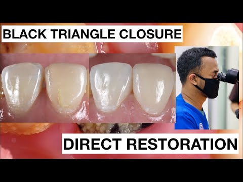 Black Triangle Closure Direct Bonding Composite Restoration