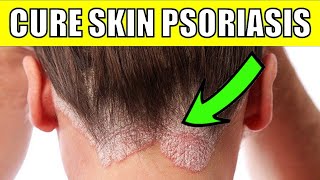 Cure Scalp Psoriasis Permanently With These 7 Natural Remedies