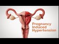 Pregnancy Induced Hypertension Part 1 Obstetrics And Gynecology Lectures