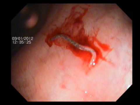 Worm in Endoscopy