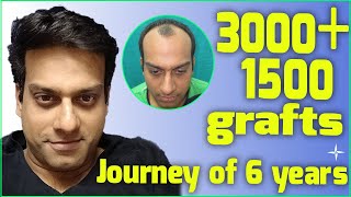 Hair Transplant -4500 DHT/FUE grafts, NW 3/4 at 6 years, Drs Sethi/Bansal
