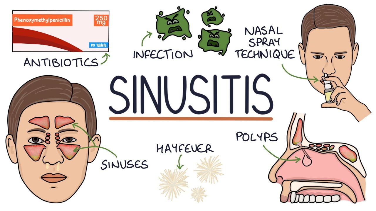 Understanding Sinusitis
