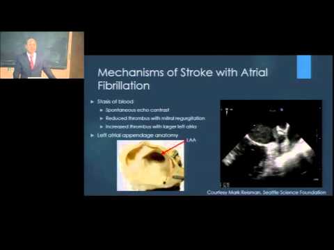 Left Atrial Appendage Closure for Atrial Fibrillation: The End of Warfarin?
