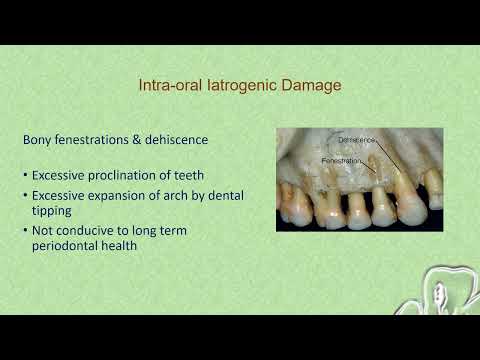 Deleterious Effects of Orthodontic Treatment
